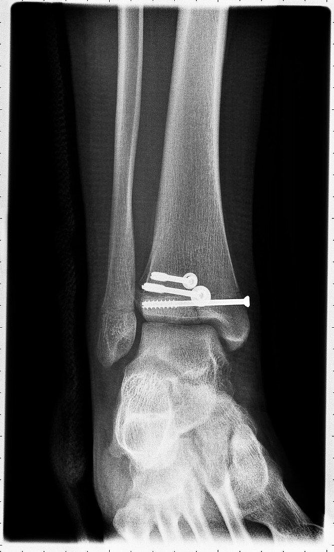 Salter Harris ankle fracture repair, post-operative X-ray