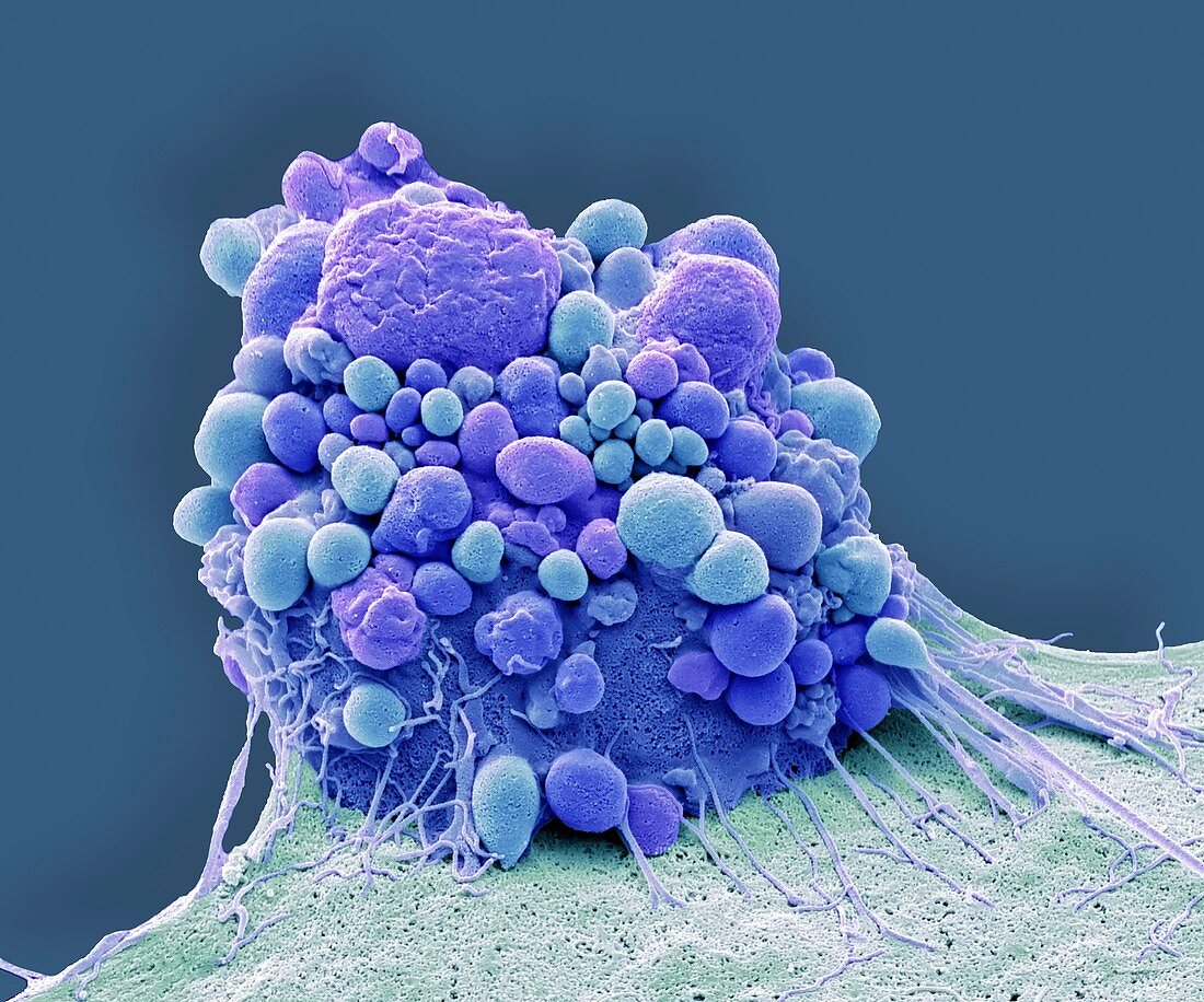 Brain cancer cell apoptosis, SEM