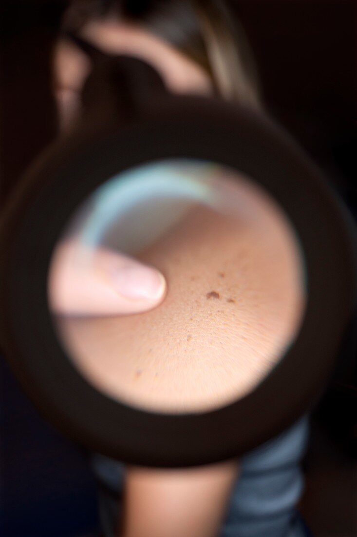 Mole being examined through dermatoscope