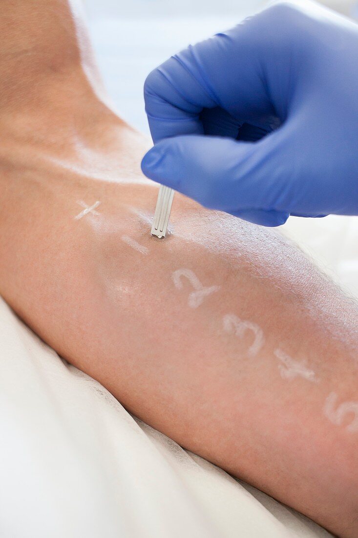 Patient undergoing a skin prick test