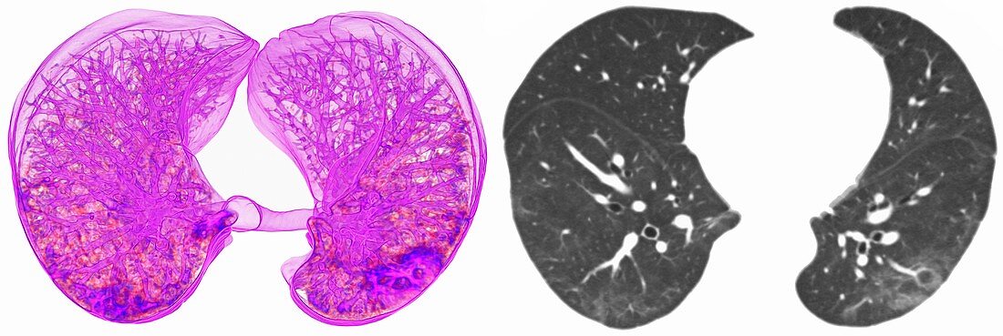 SARS-CoV lung damage, 3D and 2D CT scans