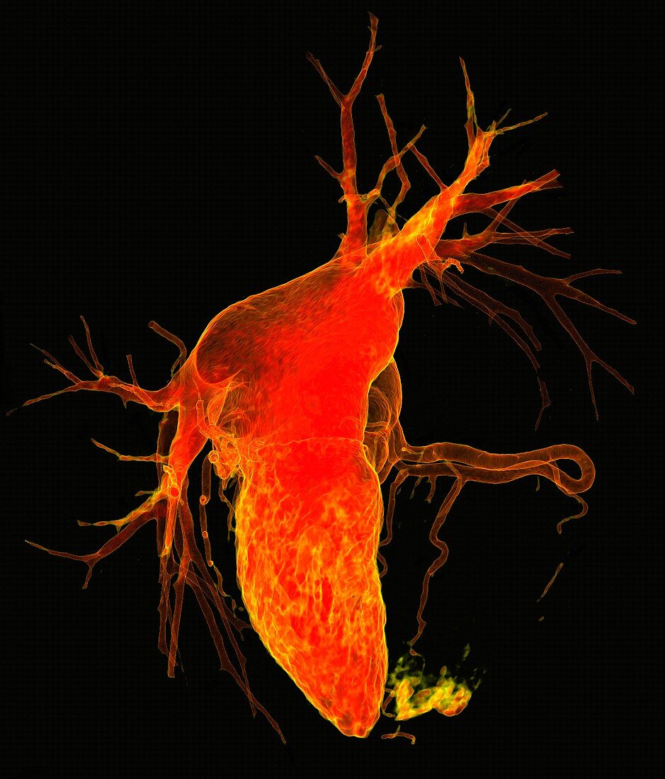 Myocardial infarction, 3D CT angiogram