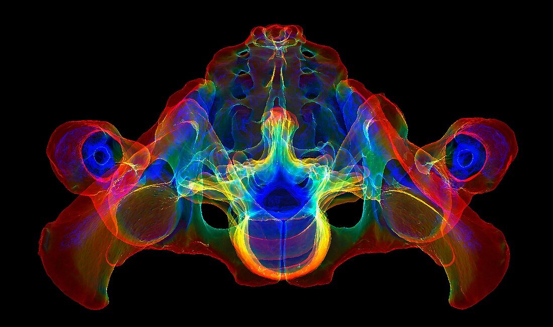 Pelvis and lumbar spine, 3D CT scan