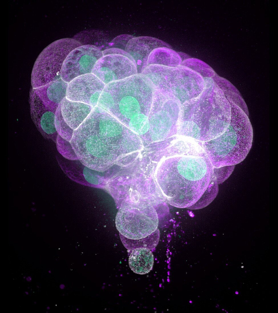 Colon cancer cells, fluorescence micrograph