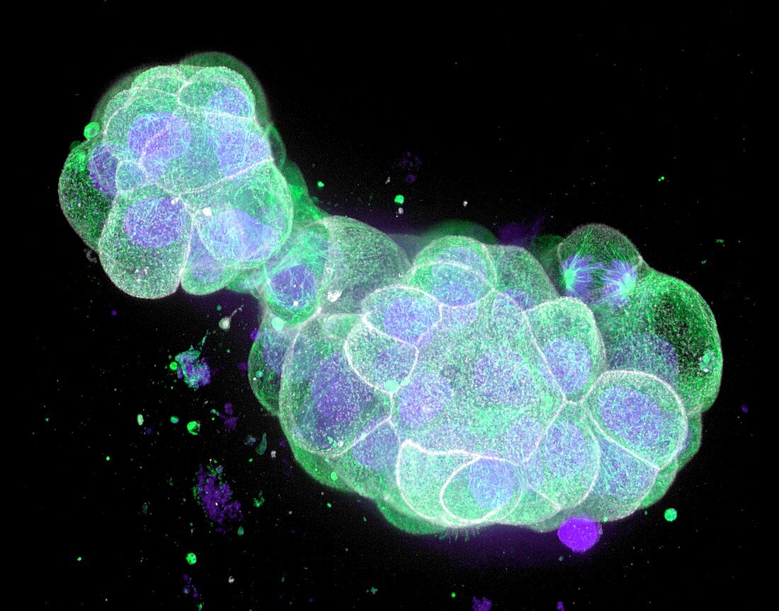 Colon cancer cells, fluorescence micrograph