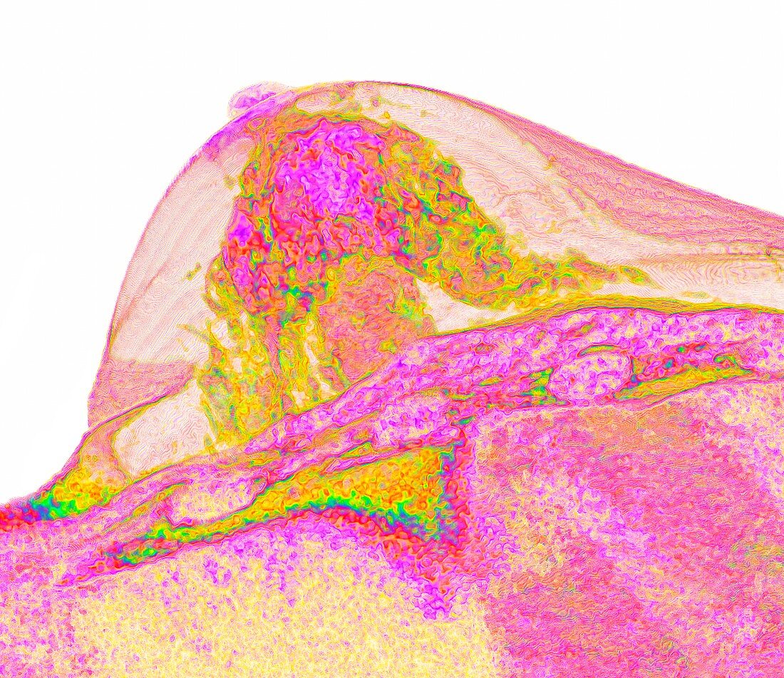 Female breast, MRI scan