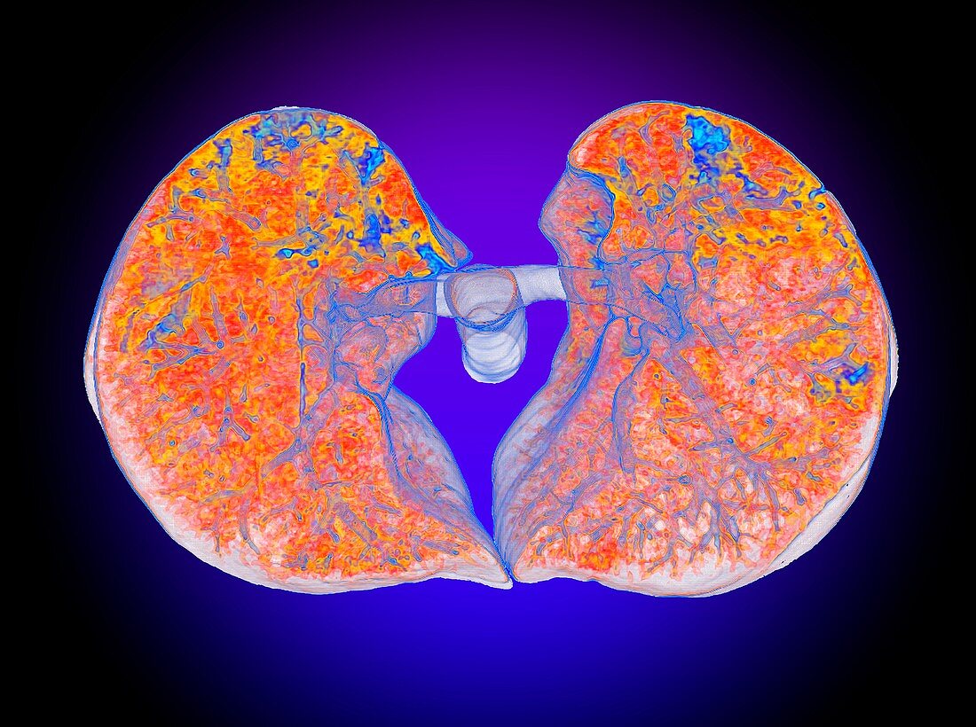 SARS-CoV lung damage, 3D CT scan