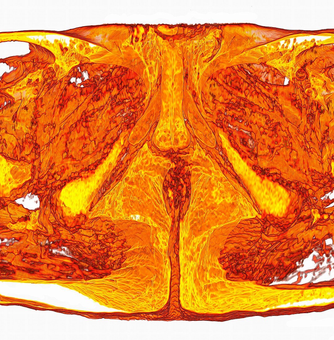 Male perineum, 3D MRI scan