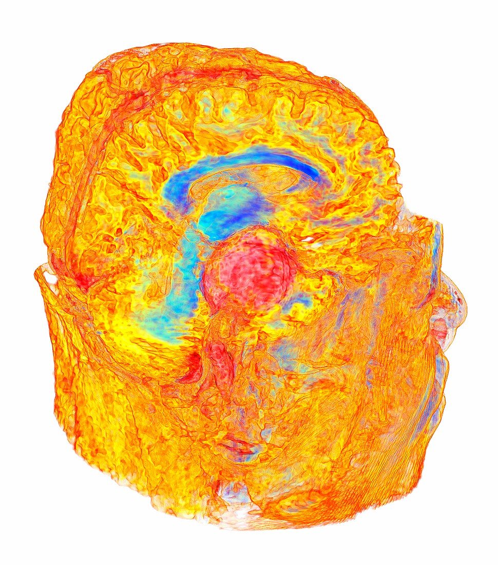 Meningioma brain cancer, 3D MRI scan
