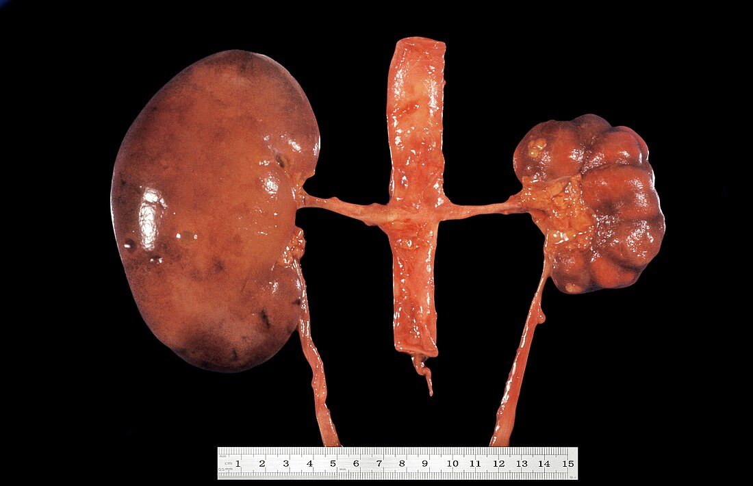Unilateral atrophy of kidney