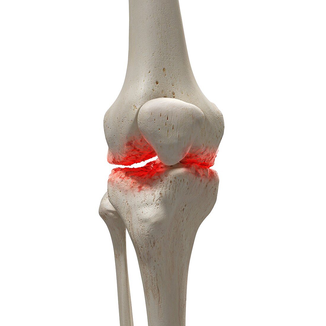 Arthritis in the knee, illustration