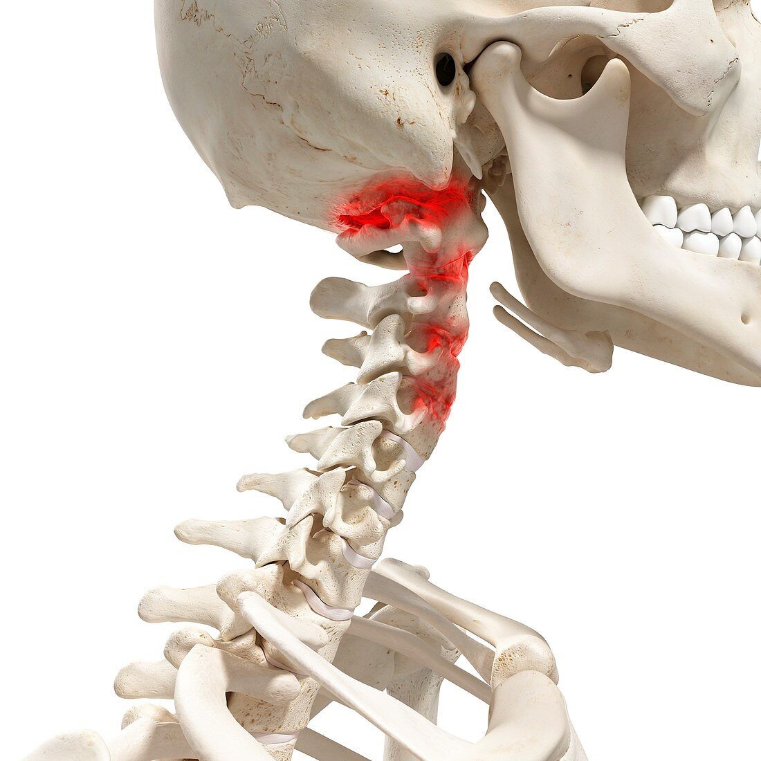 Arthritis in the cervical spine, illustration