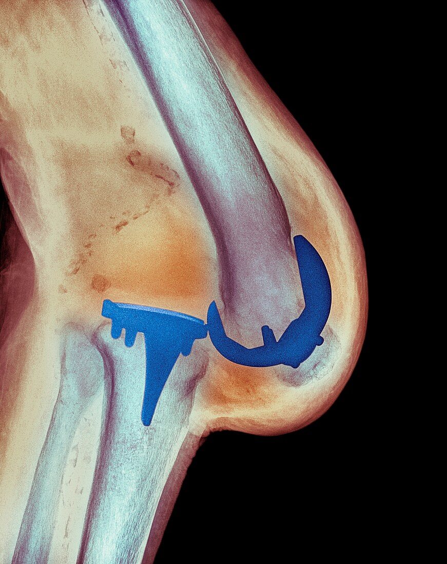 Dislocated knee, X-ray