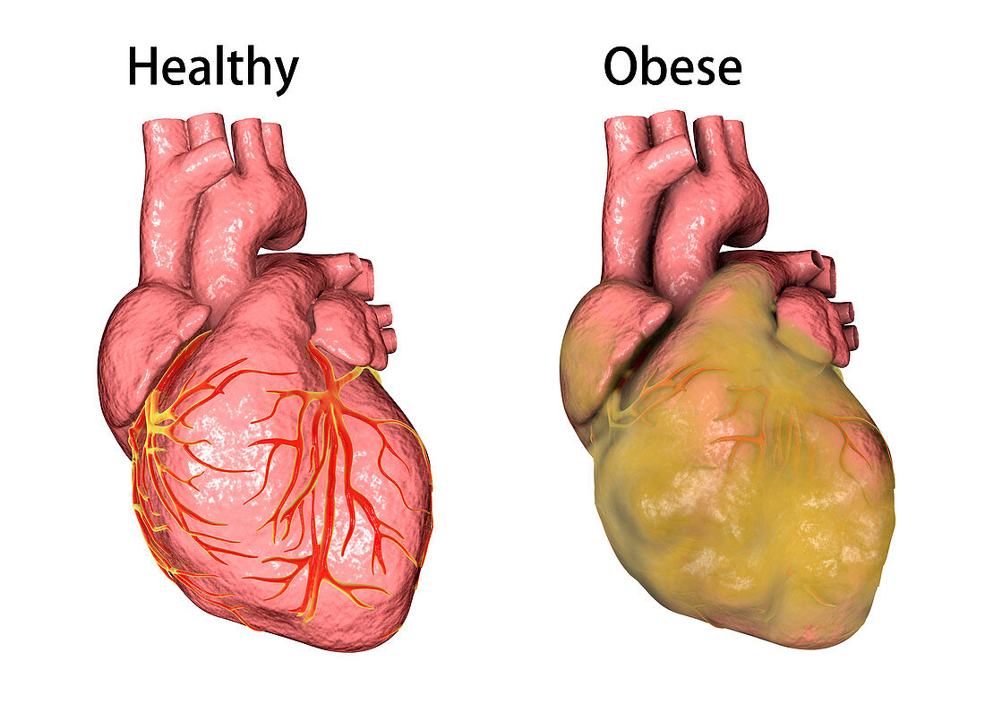 Healthy and obese hearts, illustration