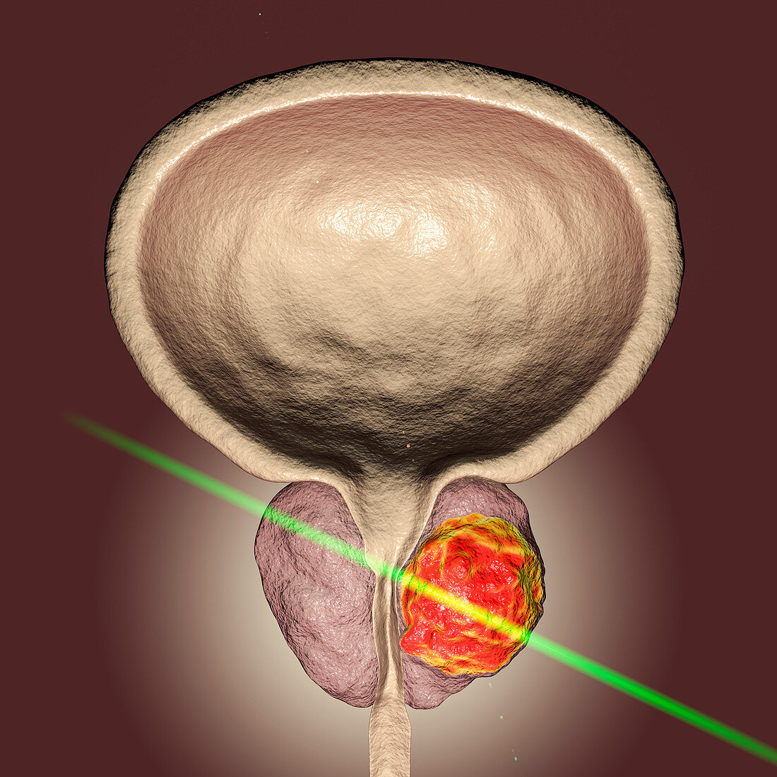Laserotherapy of prostate cancer, conceptual illustration