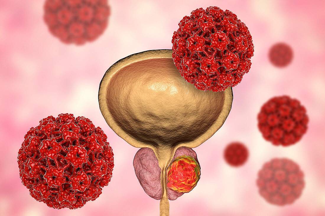 Viral etiology of prostate cancer, conceptual illustration