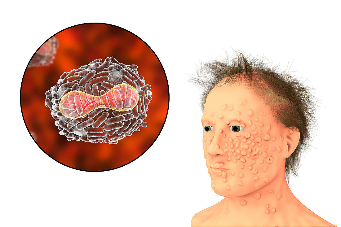 Smallpox virus and disease, illustration