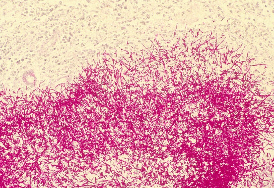 LM of Aspergillus fumigatus growing in kidney