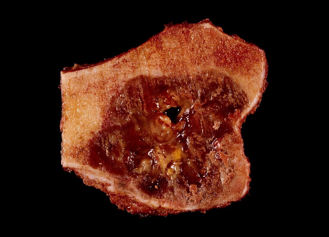 Gross specimen of femur with giant cell tumour.