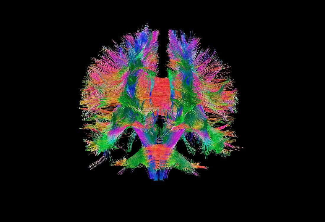 Brain fibres front view, DTI scan
