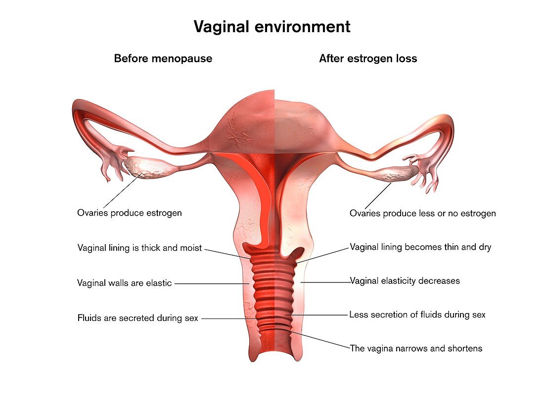 Menopause vaginal effects, illustration