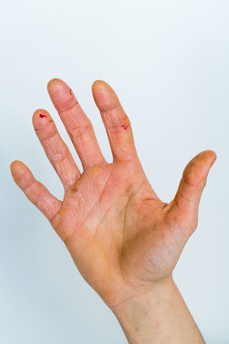 Severe eczematous rash on the hands of a woman