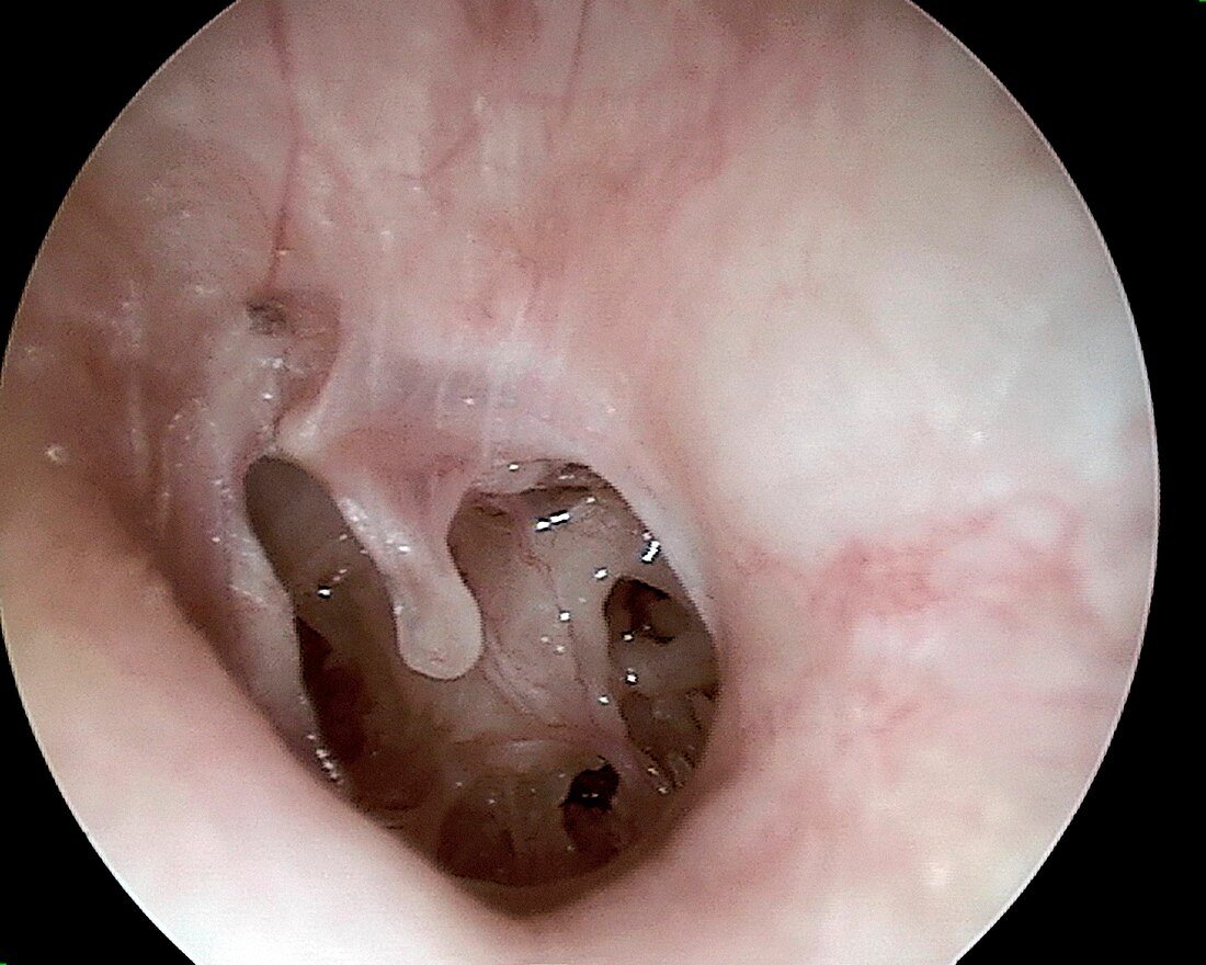 Perforated eardrum, otoscope view