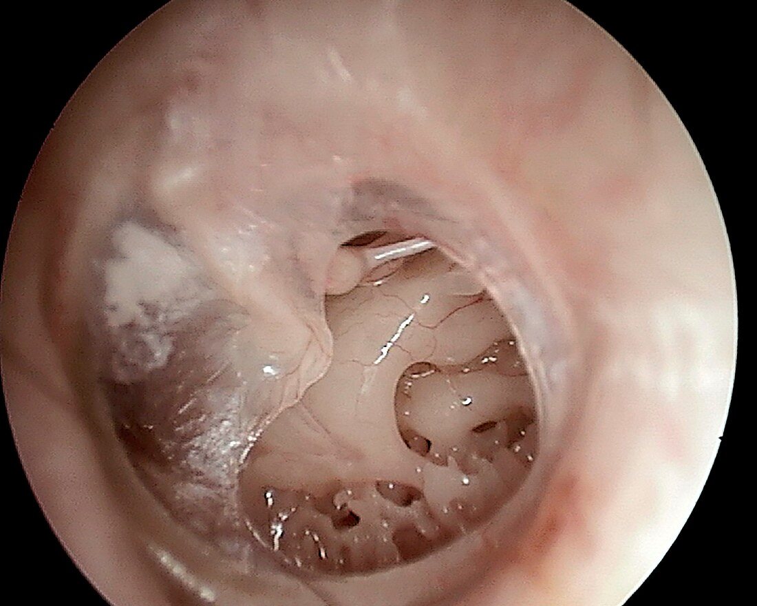 Perforated eardrum, otoscope view