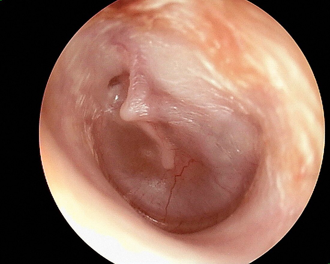Glue ear, otoscope view