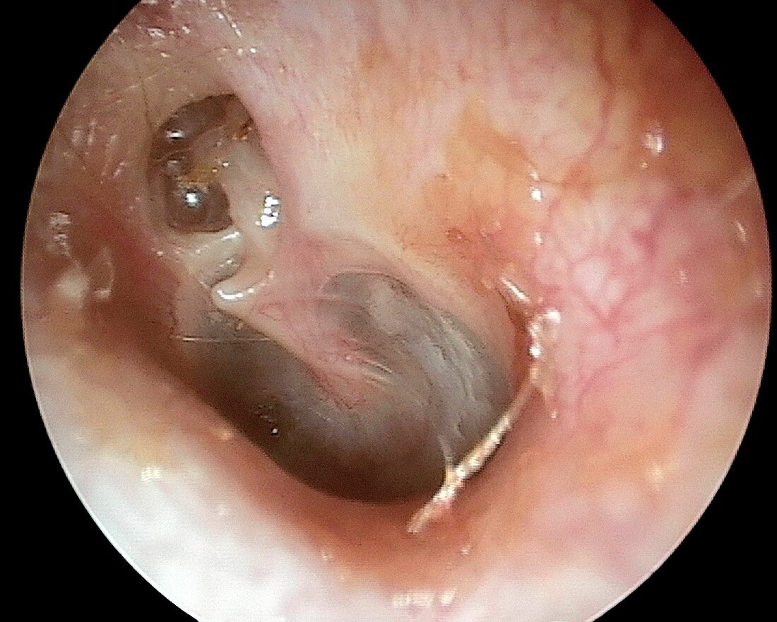Attic retraction of eardrum, otoscope view