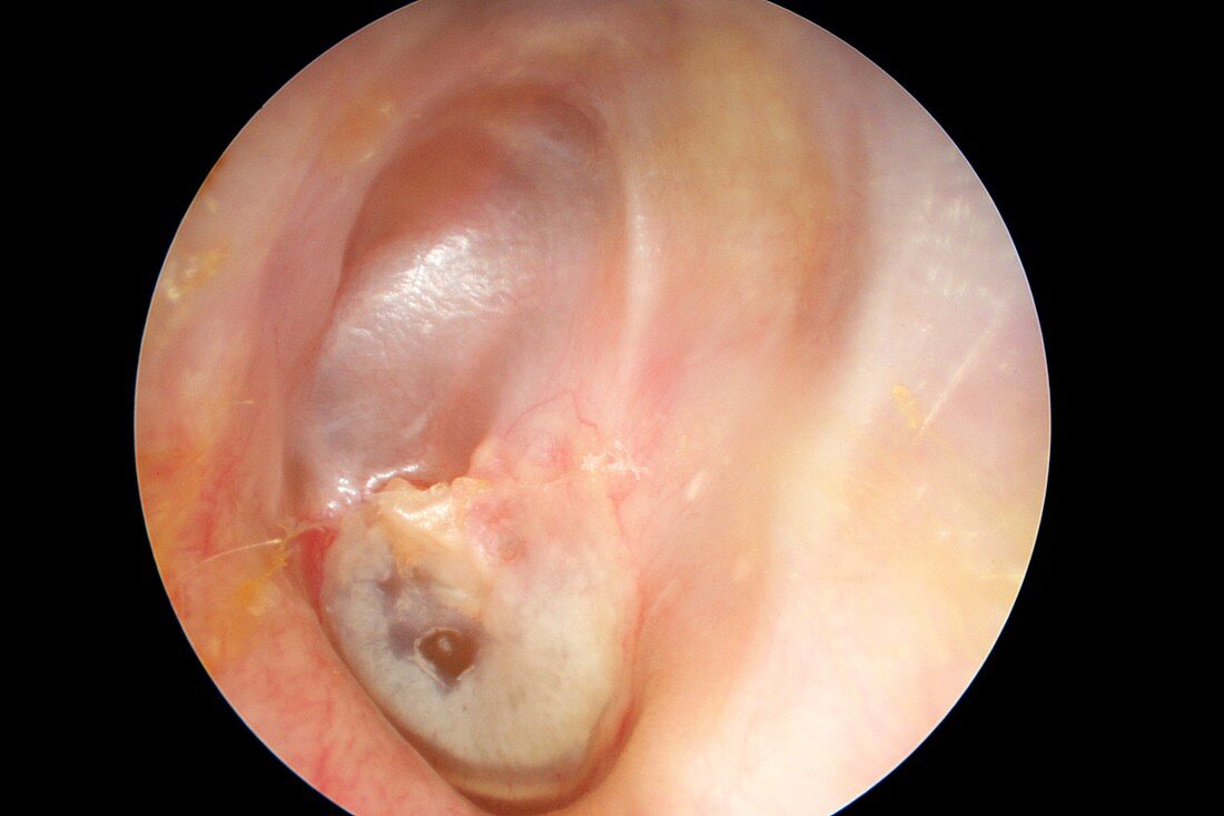 Mastoidectomy, otoscope view