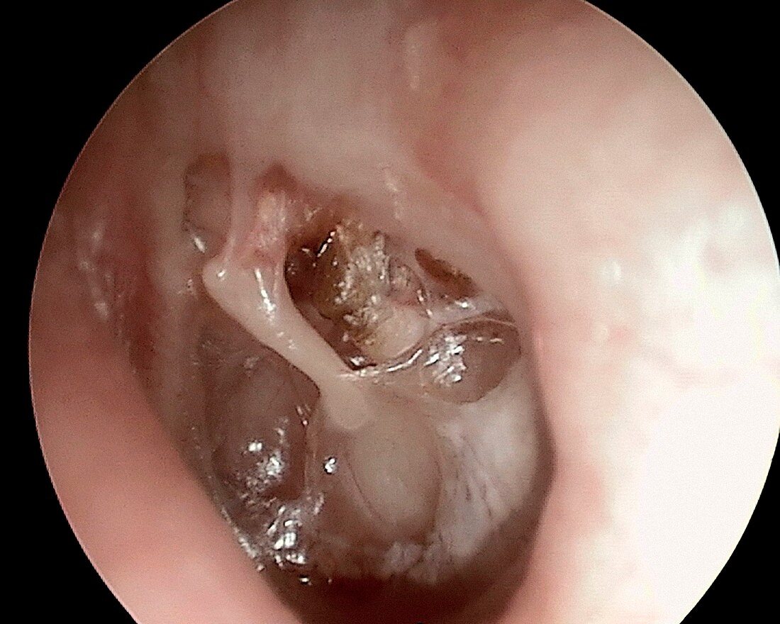 Cholesteatoma of the eardrum, otoscope view