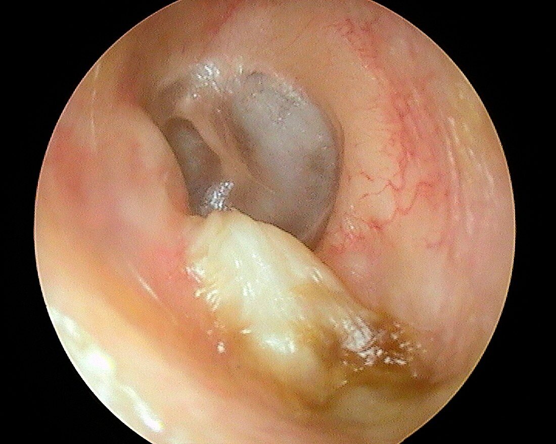 Cholesteatoma of the ear canal, otoscope view