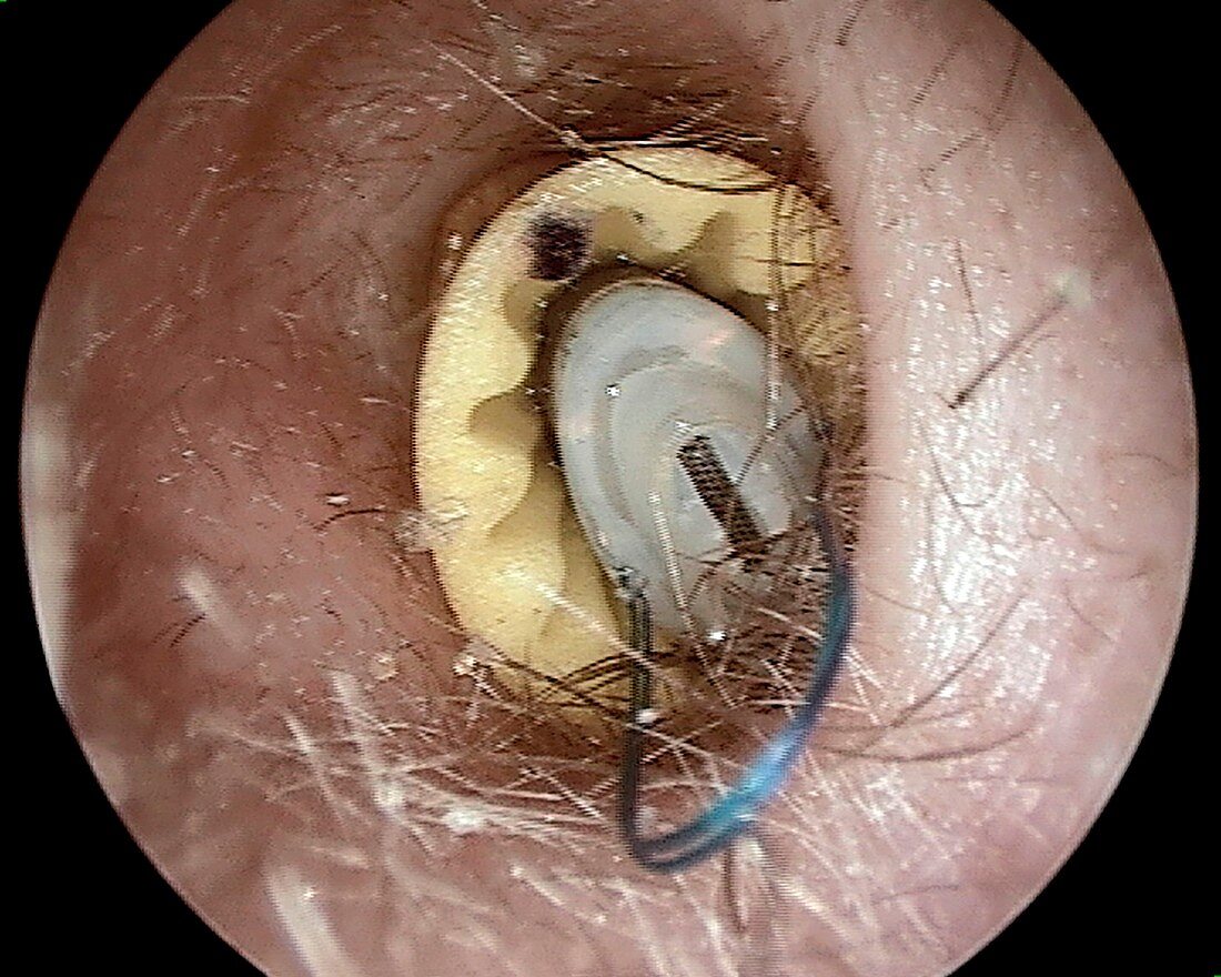 Hearing aid in the ear canal, otoscope view