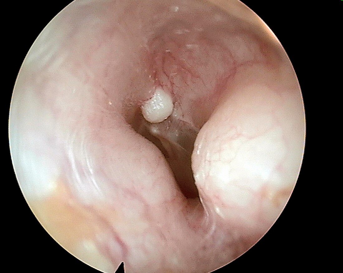 Osteoma swelling in ear canal, otoscope view