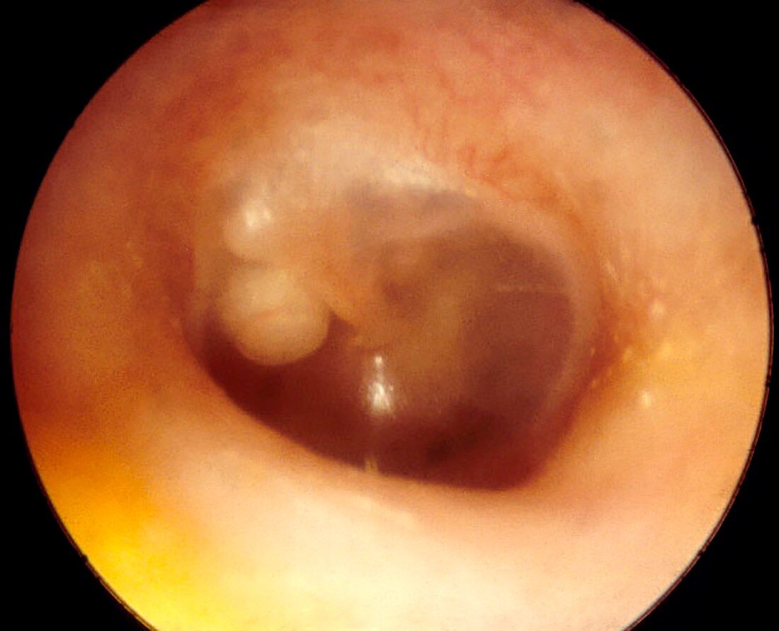 Congenital cholesteatoma, otoscope view