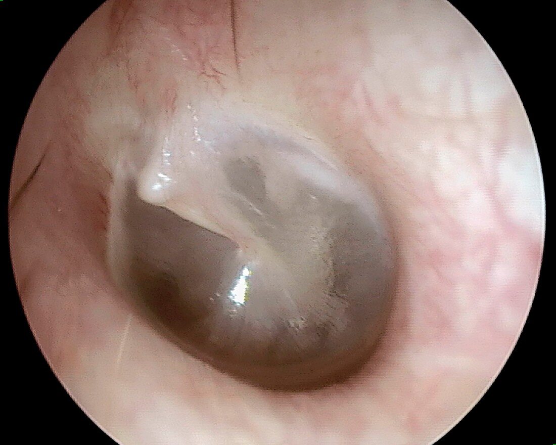 Tympanic membrane, otoscope view