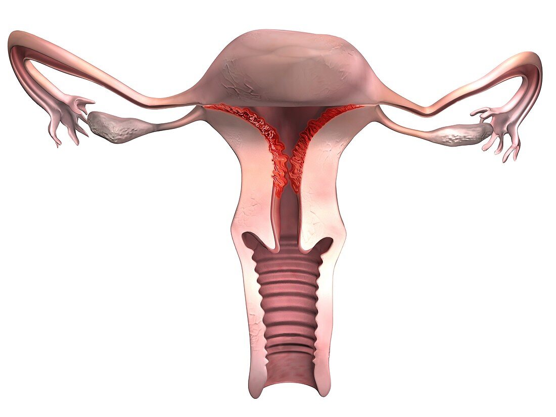 Endometriosis, illustration
