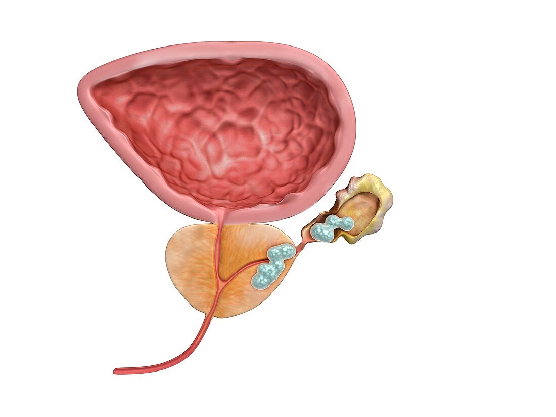 Stage III prostate cancer, illustration