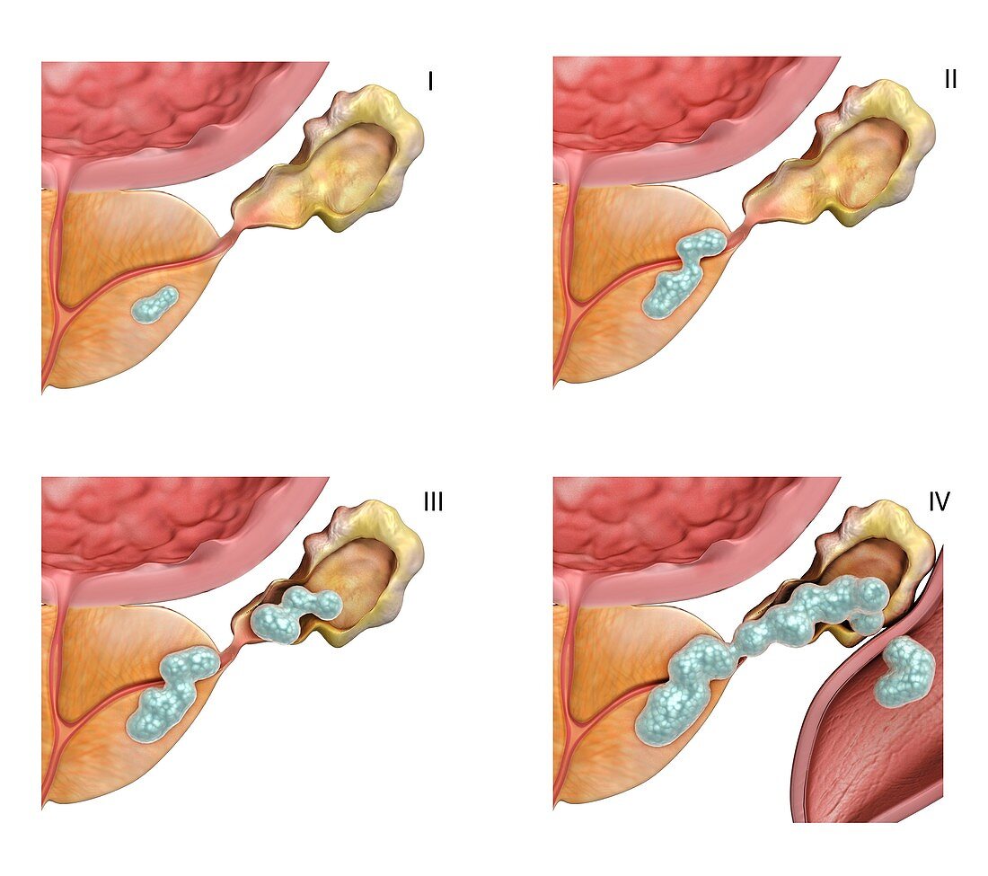 Stages I-IV of prostate cancer, illustration