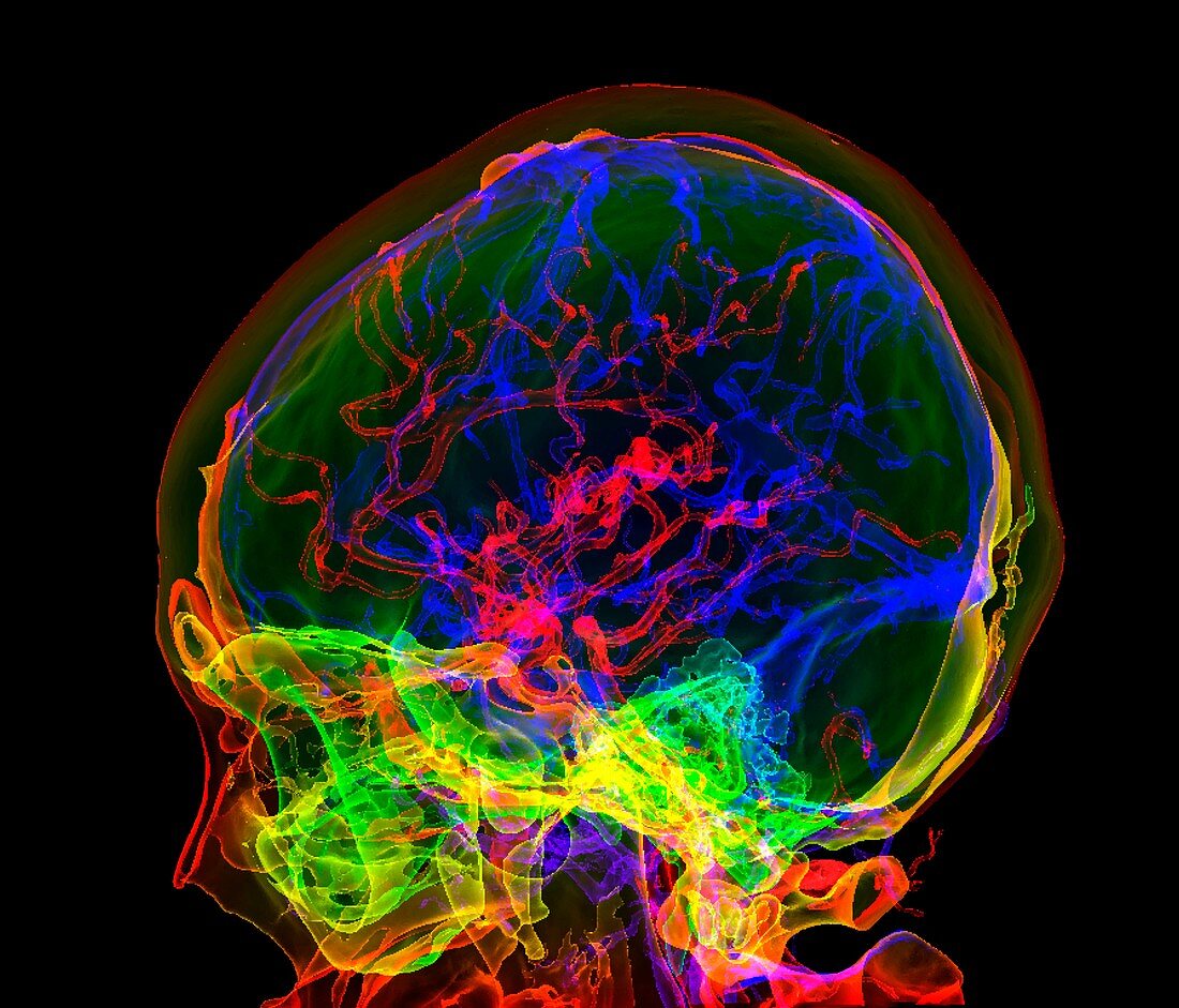 Brain blood vessels, 3D CT angiogram
