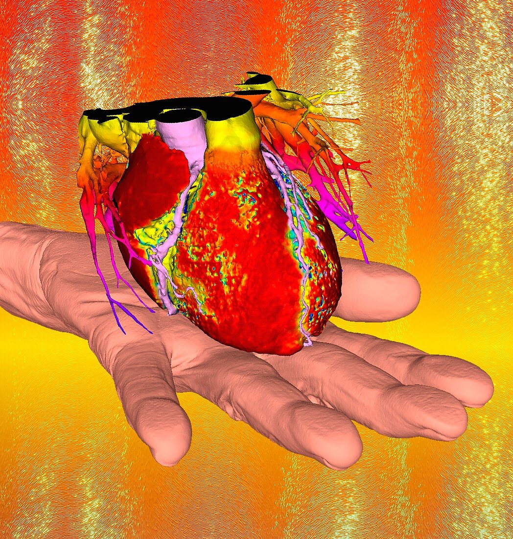 Human heart and hand, 3D CT angiogram