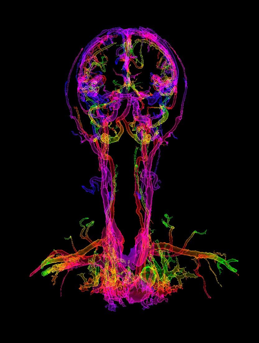 Head and neck blood vessels, 3D CT angiogram