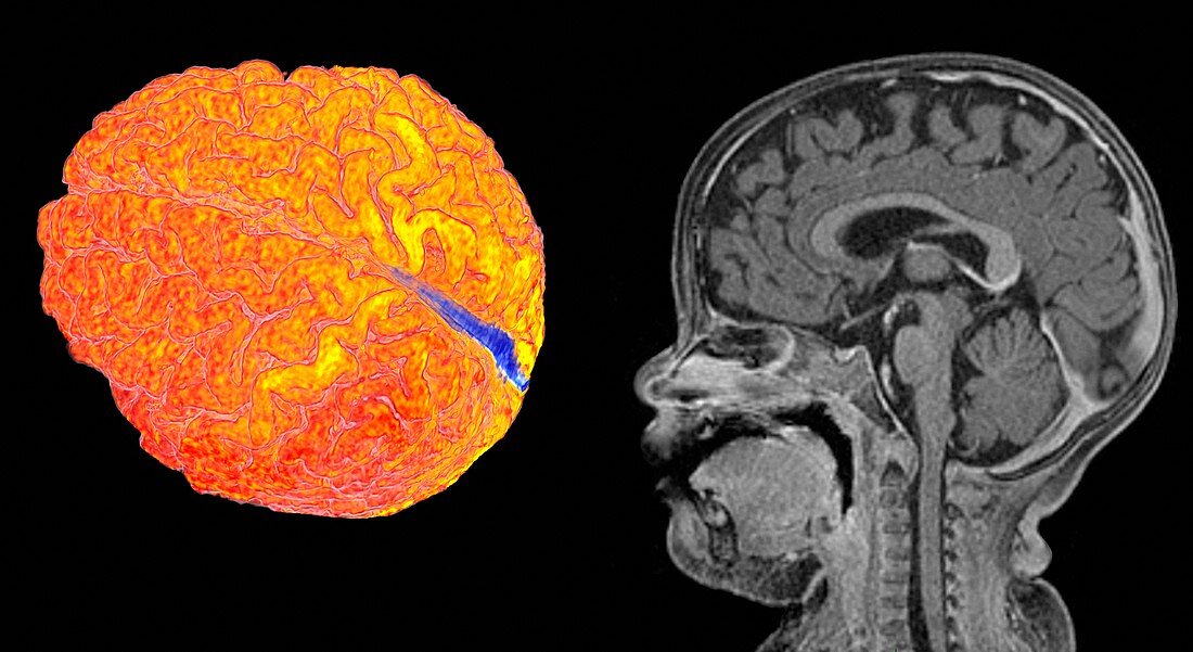 Child's brain and head, 3D and midline sagittal MRI scans
