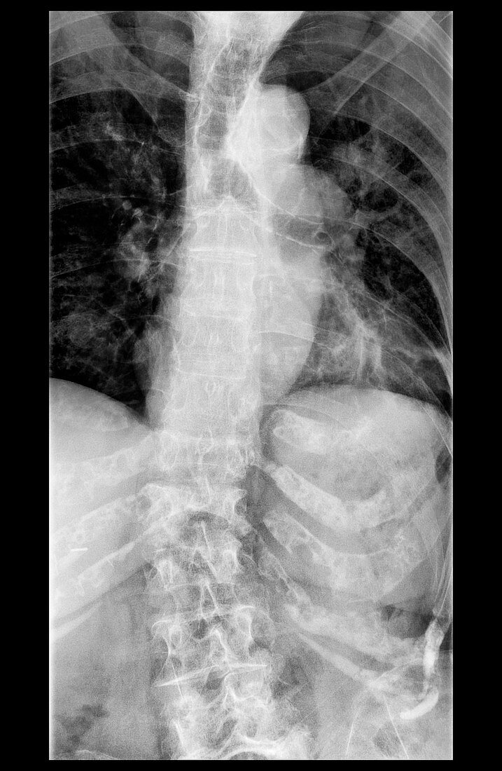Thoracic vertebral collapse, X-ray