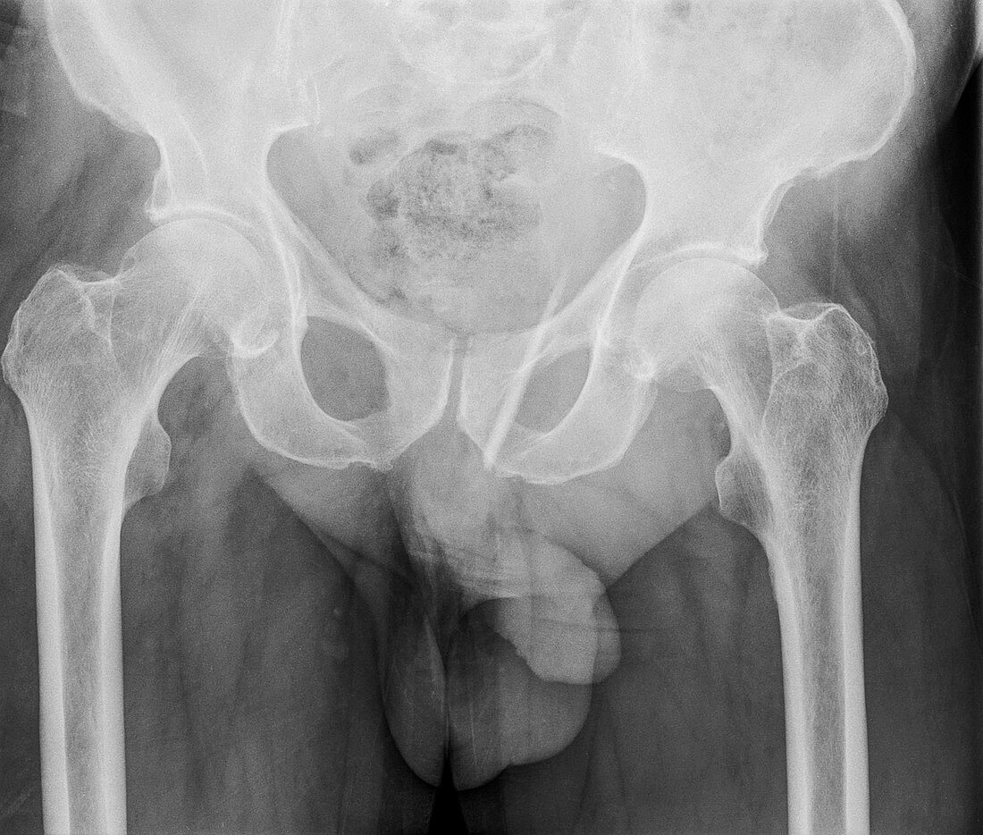 Glass shard in buttocks, X-ray