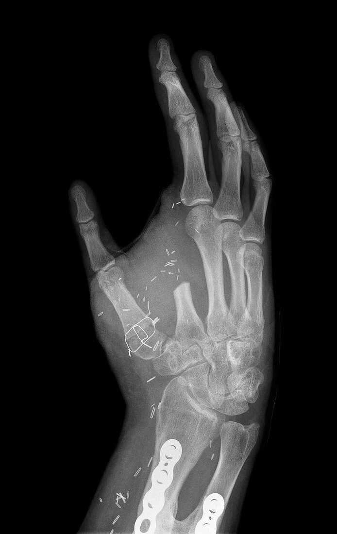 Thumb created from index finger, X-ray