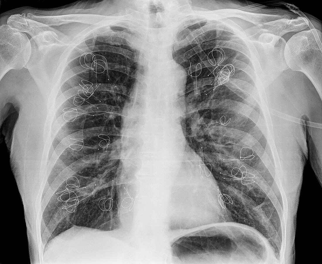 Implanted lung volume reduction coils, X-ray