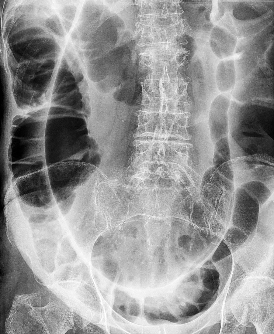 Twisted colon, X-ray