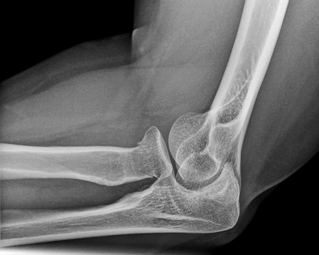 Fracture of elbow bone, X-ray